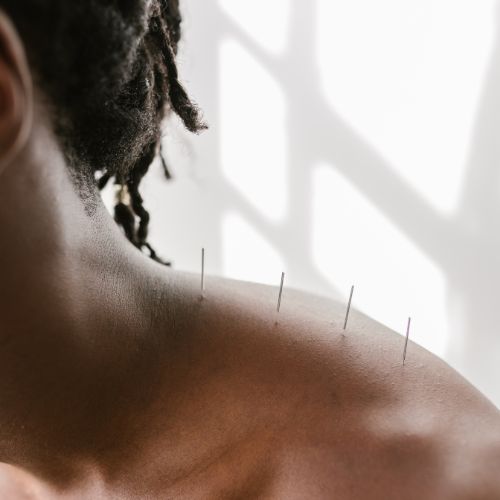 Acupuncture 